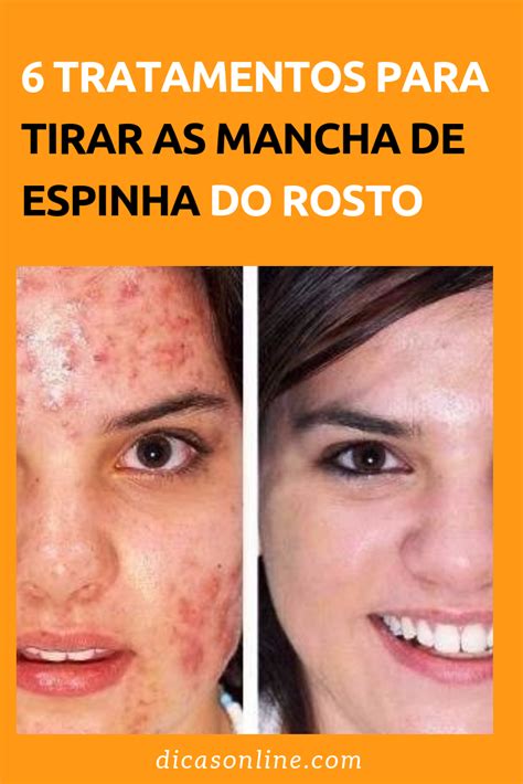 O Que Tira Mancha De Espinha - Como tirar mancha de espinha do rosto | Manchas de espinhas, Tirar ...