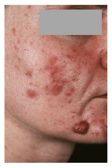 Adrenal Fatigue Cystic Acne at Toby Mcintosh blog