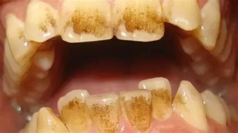 coffee stains teeth