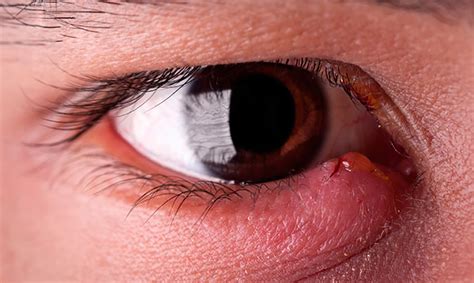 Effective Home Remedies For Eye Styes – The Rebel Pharmacist