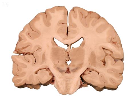 Coronal brain section labels Diagram | Quizlet