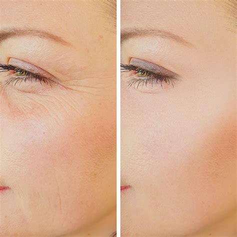 PRP Fillers - Injectable Fillers - Santa Rosa and Healdsburg