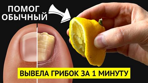 От ГРИБКА НОГТЕЙ можно избавиться за 1 минуту простым... Это точно есть ...