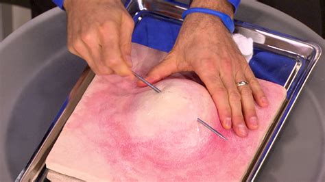 Dr. Oz Demonstrates How to Properly Pop a Pimple - Video