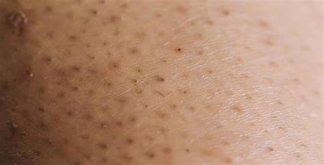 how to avoid ingrown leg hairs