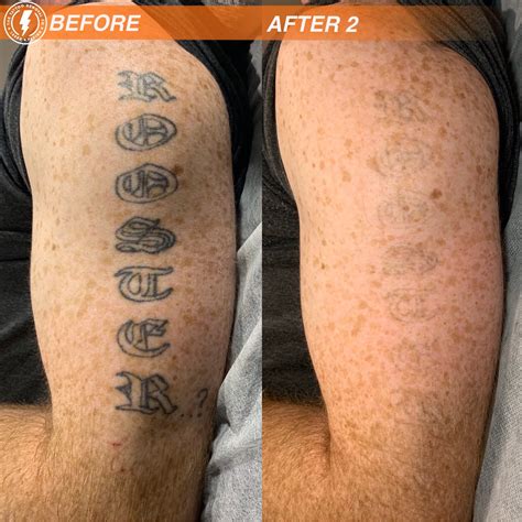 The Tattoo Removal Co.-Laser Tattoo Removal Adelaide