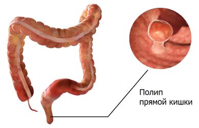 Je nutné odstranit polypy v konečníku?