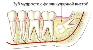 Киста челюсти: классификация, симптомы, диагностика, хирургия