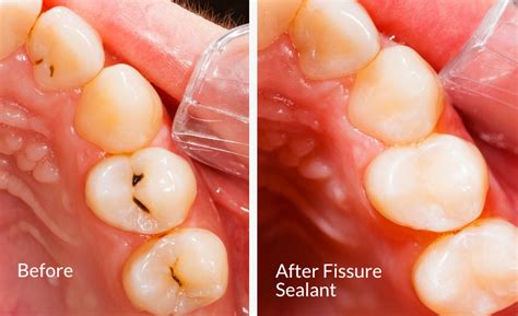 pit  fissure sealants