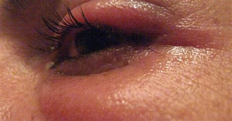 Detalles que desconoces sobre los orzuelos y otras afecciones en los ojos