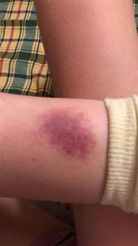 Matthew Hankins on Twitter: "Two-day old insect bite (?) on 11yo's leg ...