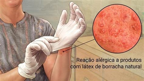 Alergia A Luva De Latex - Alergia ao Látex - Luvas para Procedimento
