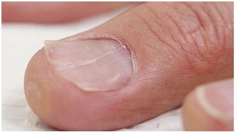Iron Deficiency Anemia Nails