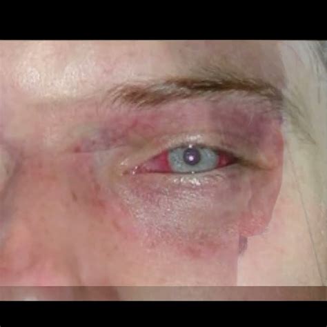 Barotrauma Symptoms and Causes - Diagnosis - Treatment - Prevention # ...