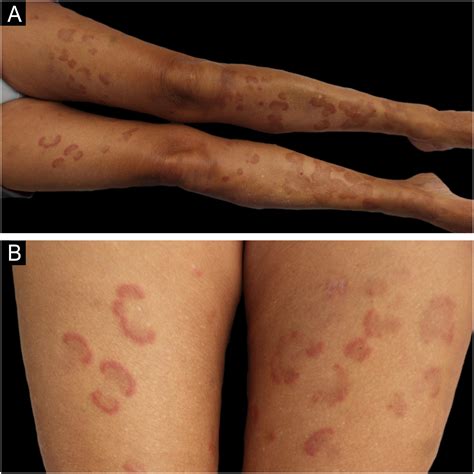 A case of eosinophilic annular erythema as a presenting sign for