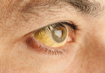 Leptospirosis Rash