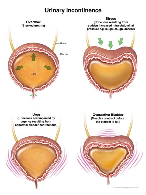 Best 13 Urinary Incontinence: Types, Causes, Symptoms And Treatment
