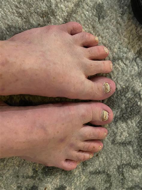 How to cure nail fungus of 15+ years : r/NailFungus