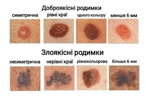 Что следует знать о родинках — диагностика и дерматоскопия в Киеве ...