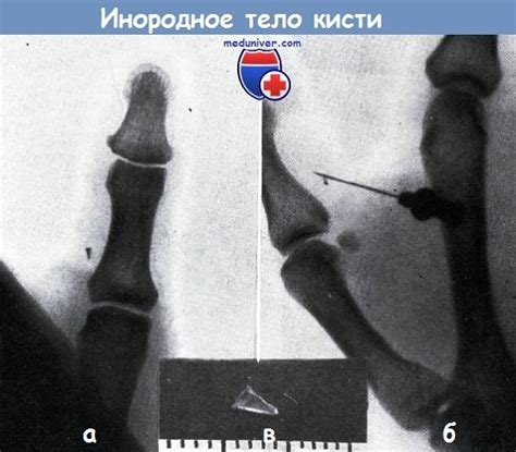 Лечение инородных тел кисти