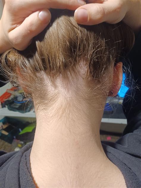 hairlosstaway32 (u/hairlosstaway32) - Reddit