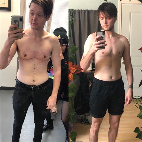 it’s my chest’s birthday today! top surgery results two years apart : r/ftm