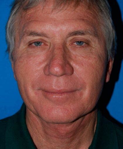 facelift  men  boca raton fl dr gregory albert