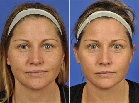 clear  brilliant  hyperpigmentation   expect