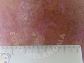 Актинична кератоза - Euromelanoma