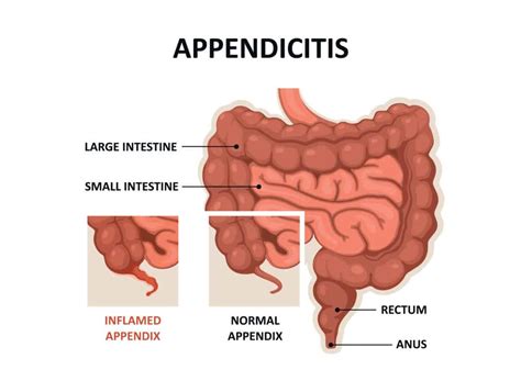 appendicitis drug genius