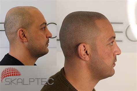 receding hairline treatment  stages  treatment skalptec