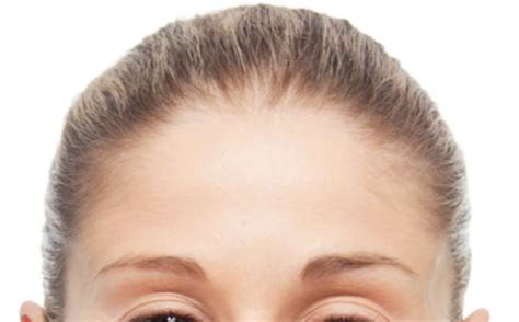 sem queixo ou queixo demais cirurgia reposiciona maxilar