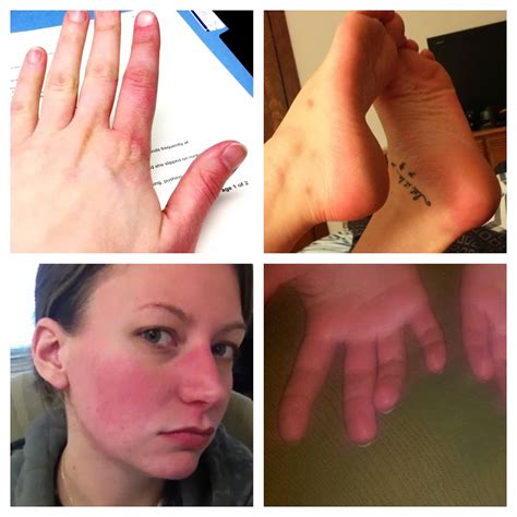 what causes flushing on face 9