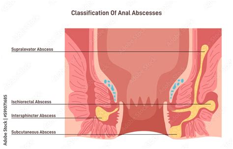 how to treat anus abscess at home