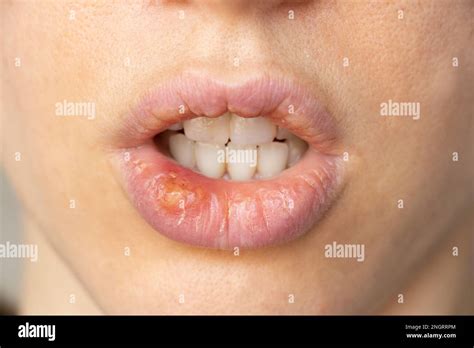 Simplex herpes on the lips of a girl close-up, a group of viral ...