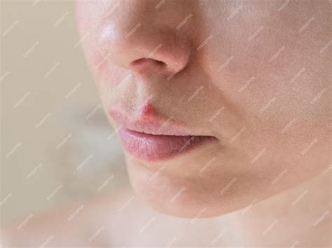 Premium Photo | Cold sores. close-up of the female face, selective focus.