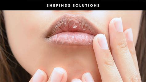 Once And For All, Here’s How To Heal Dry, Cracked Lips # ...