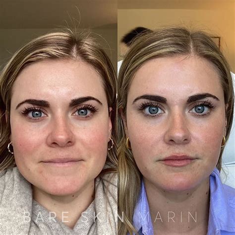 Facial Balancing | Bare Skin Marin