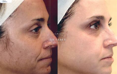 Forever Young BBL Werribee, Melbourne | BBL Rosacea | Dr Saber