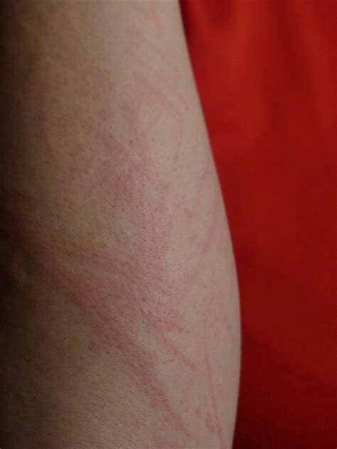 Staph Infection Early Stages Rash