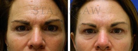 Skin Care Gallery 1 Before and After Photos Connecticut