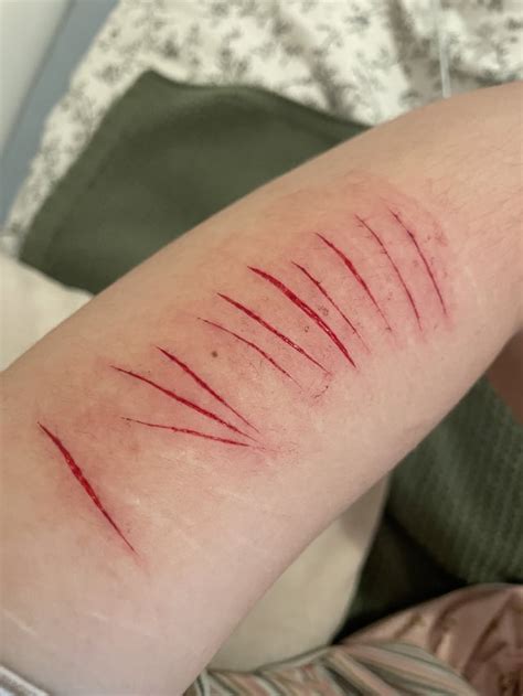 how to know if i need stiches