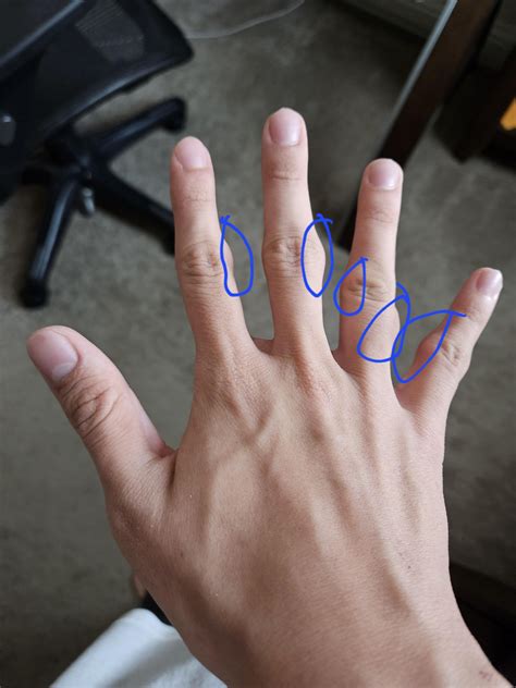 19 [M] for a while now I've had these strange bumps on my fingers. : r
