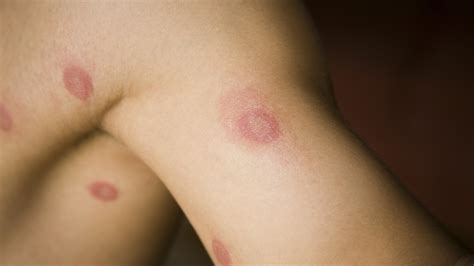 Ringworm on children | Vital Health Zone