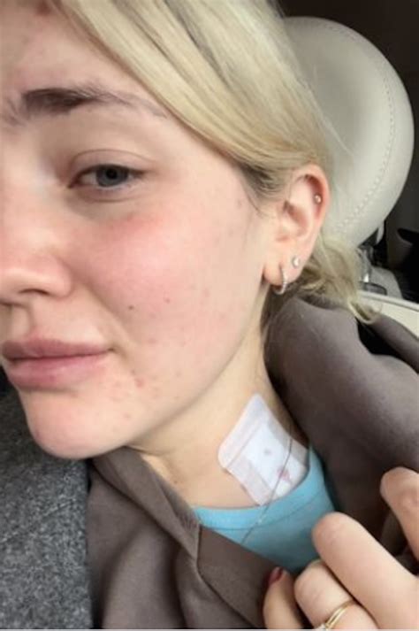 College Grad, 23, Dismissed Headaches As Alcohol Allergy: It Was Cancer