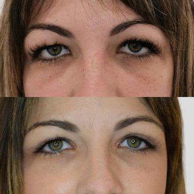 Eliminar ojeras con ácido hialurónico. Cómo se hace - Dr. Joan San Miguel