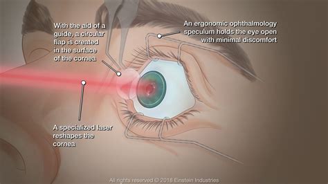 LASIK Erie, PA - Contemporary Ophthalmology of Erie