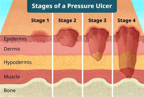 Pressure Ulcer: Bedsore Treatment for Stages 1 through 4