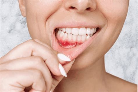 stage  floor  mouth cancer  key facts liv hospital