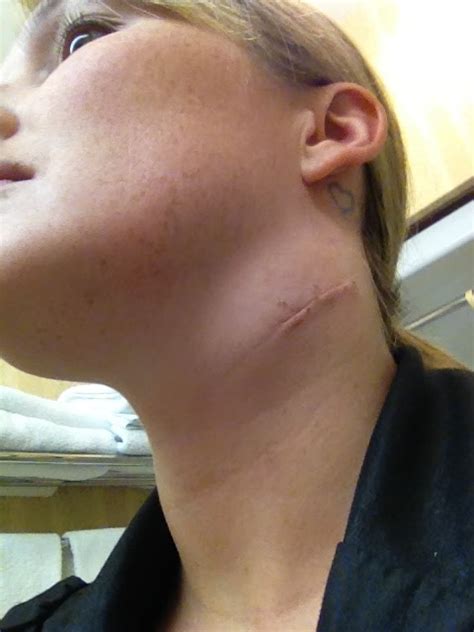Early stage swollen lymph nodes in neck cancer - ejuluX